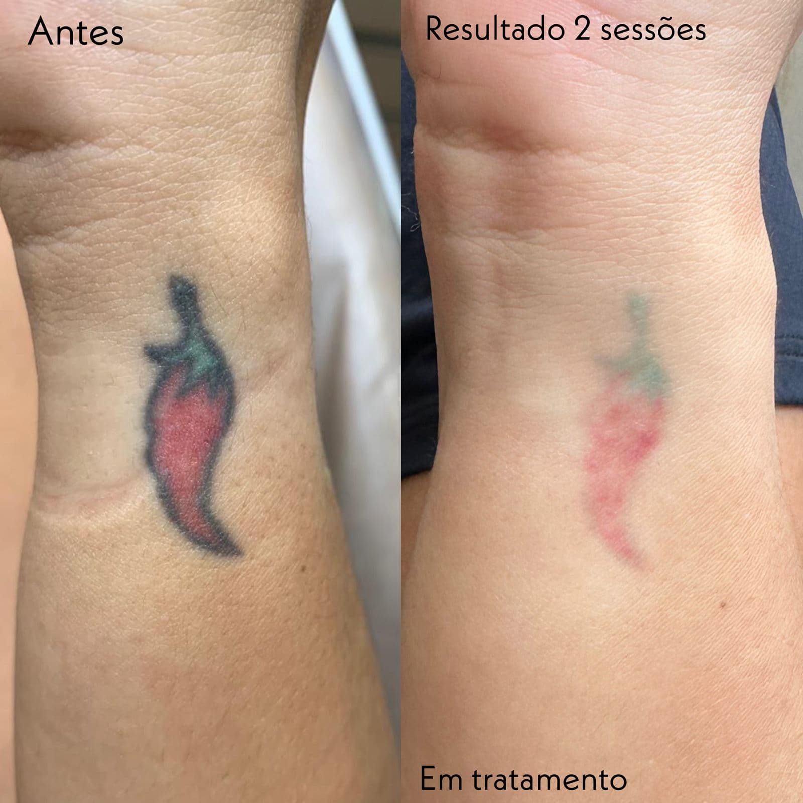 Resultado Clínico 4 - Dr Jacson